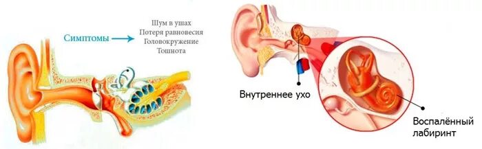 Воспаление среднего уха (лабиринтит);. Воспалительные заболевания внутреннего уха (лабиринтиты).. Воспаление внутреннего уха лабиринтит. Внутренний отит (лабиринтит). Внутреннее ухо лечение и симптомы