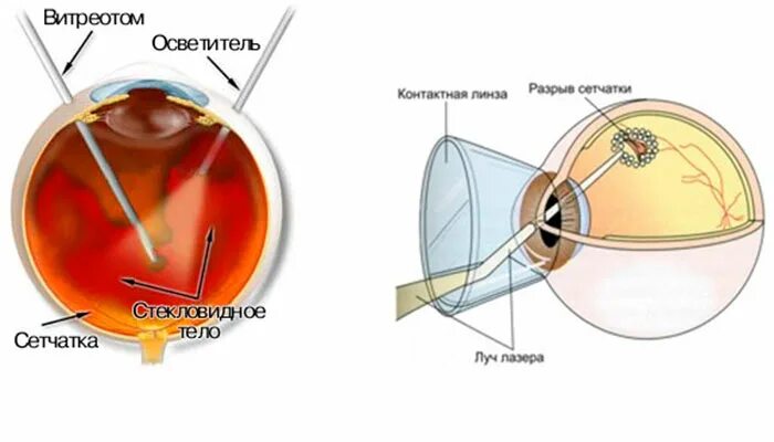 После операции сетчатки глаза ограничения. Отслоение сетчатки глазное дно. Лазерная коагуляция сетчатки глаза. Лазерокоагуляция сетчатки. Отслойка сетчатки лазерная коагуляция.