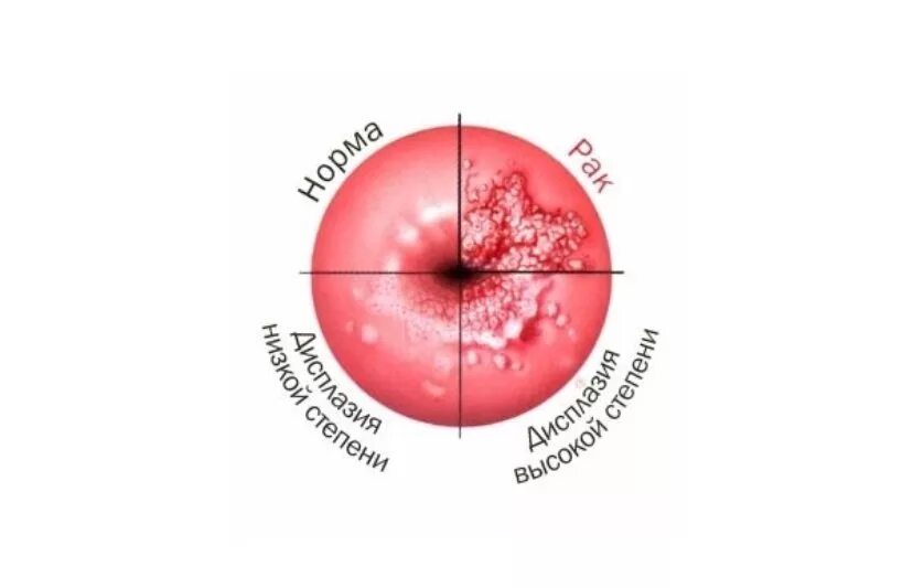 Умеренная дисплазия шейки матки что это. Дисплазия шейки матки проба Шиллера. Дисплазия шейки матки 1 степени степени что это такое. Кольпоскопическая картина дисплазии шейки. Дисплазия шейки 1 степени.