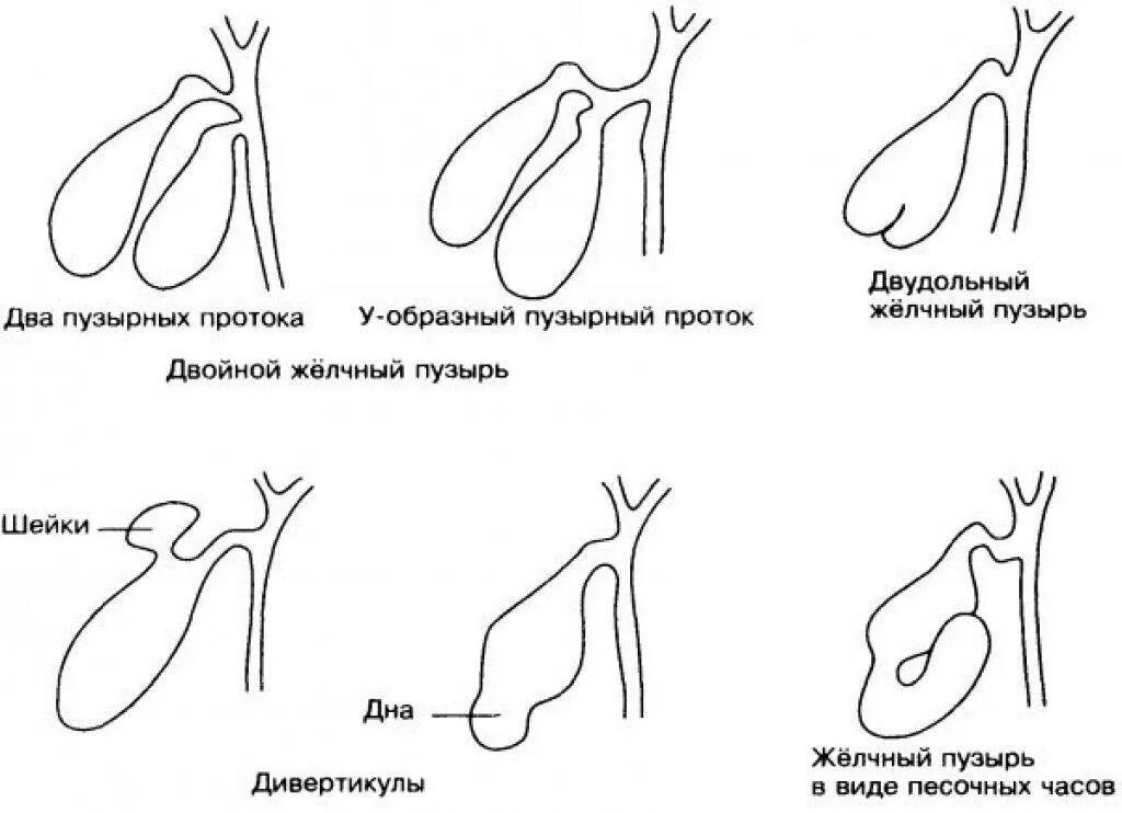 Перегиб желчного пузыря что делать. S образный загиб желчного пузыря. Перегиб шейки желчного пузыря. Деформированная форма желчного пузыря. S образный изгиб шейки желчного пузыря.