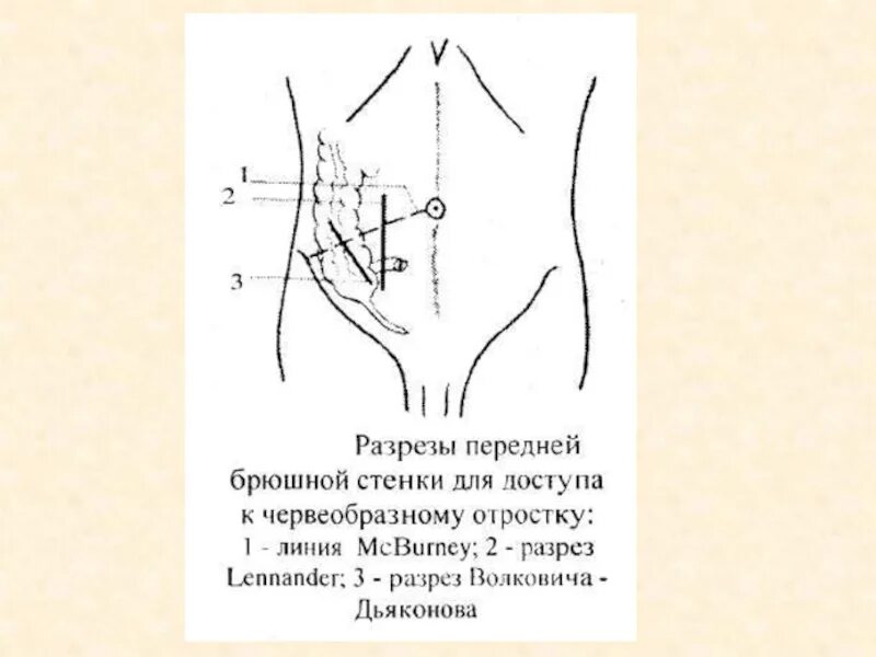 Точки аппендицита. Точка Мак Бурнея Волковича Дьяконова. Волковича Дьяконова Мак Бурнея аппендэктомия. Параректальный разрез по Ленандеру. Доступ Волковича Мак Бурнея.