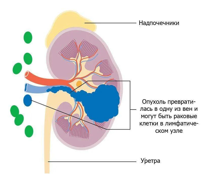 Лимфатические узлы почки. Регионарные лимфоузлы почки.