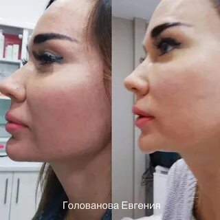 Липолитики для лица сколько процедур