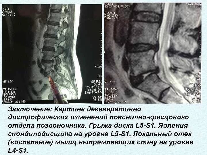 Картина дистрофических изменений пояснично крестцового отдела