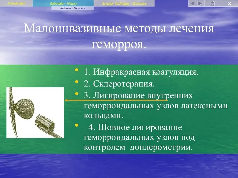 Легировпние латексными кольцами. Легирование геморроя. Лигирование узлов латексными кольцами. Лигирование геморроидальных узлов латекс-кольцом. Дезартеризация геморроидальных узлов методом hal.