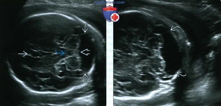 Большая цистерна больше нормы. Большая цистерна плода УЗИ. Расширение большой цистерны у плода. Большая цистерна мозга расширена. Расширение большой цистерны.