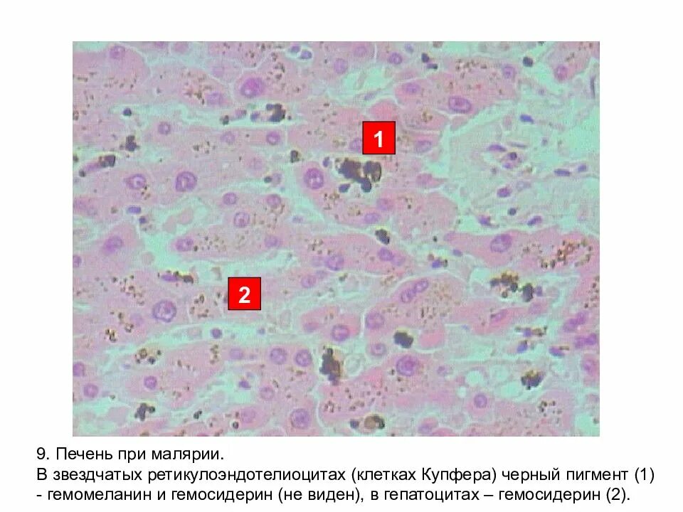 Печень при малярии микропрепарат. Малярийная пигментация печени микропрепарат. Звездчатые макрофаги (клетки Купфера) печени способны:. Печень при малярии гепатоциты с гемосидерином. Печень микропрепарат описание