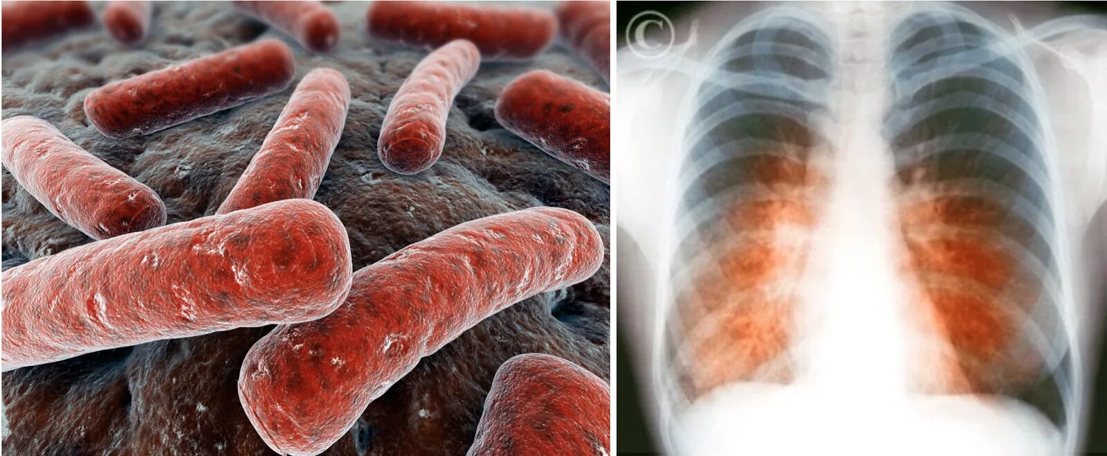 Туберкулез tuberculosis. Палочка Коха туберкулез. Бациллярный туберкулез. Tuberkulyoza.