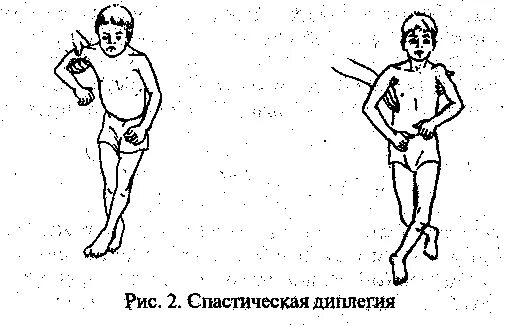 Спастическая диплегия форма ДЦП. Спастическая гемиплегия ДЦП. Спастическая диплегия (синдром Литтля). Спастическая диплегия зоны поражения ГМ. Гемипаретическая форма дцп