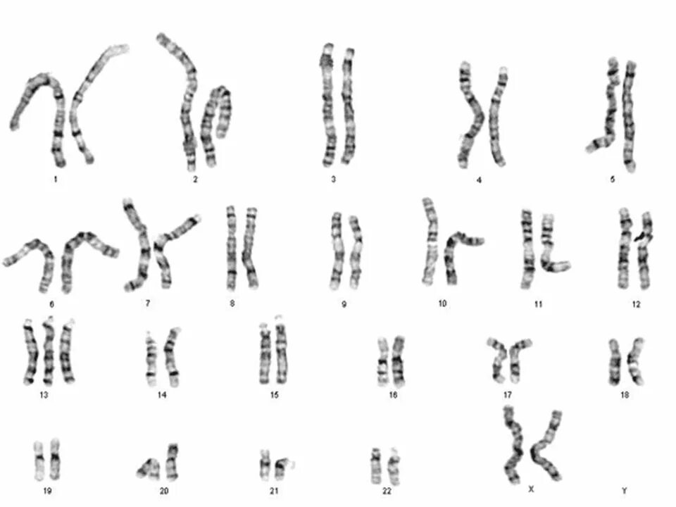 Синдром Патау кариотип. Синдром Патау (трисомия 13-й хромосомы). Синдром Патау кариограмма.