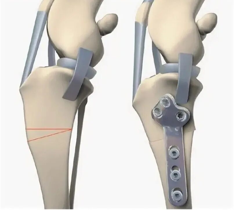 Разрыв связки у собаки. Тибиальная остеотомия. Тройная остеотомия большеберцовой кости. Пластина для фиксации ПКС.
