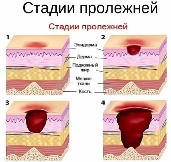 Сколько заживает глубокий. 1 Стадия пролежней картинки. Пролежни стадии 4 стадии. Пролежни у лежачих больных.