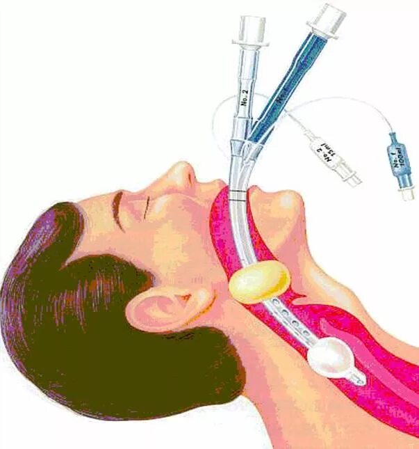 Интубационная трубка ИВЛ. Анестезия: эндотрахеальный наркоз.. Интубация трахеи эндотрахеальной трубкой. Дышать через трубочку