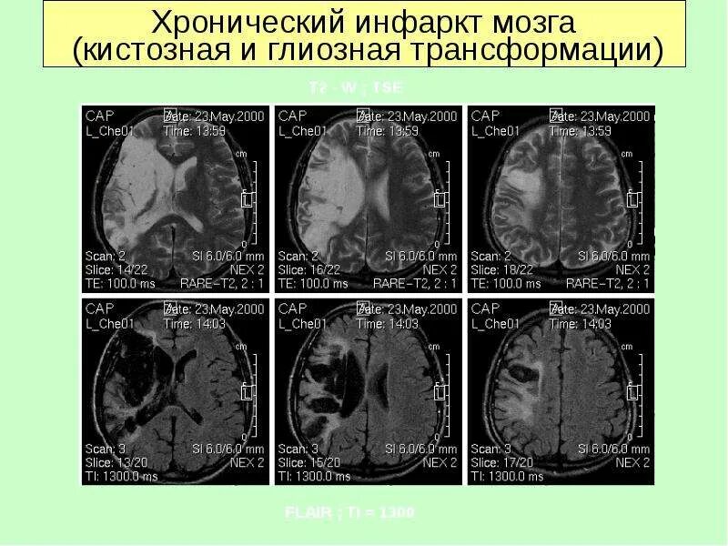 Кистозно глиозные изменения головного мозга что это. Кистозно-глиозные изменения головного мозга мрт. кистозно-глиозная трансформация. кистозно глиозная трансформация вещества головного мозга. кистозно-глиозная трансформация головного мозга мрт.