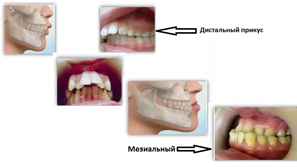 Зубы при закрытом рте. Дистальный прикус челюсти. Дистальный прикус ретрузия. Ортогнатия мезиальный прикус. Дистальный прикус это патология.