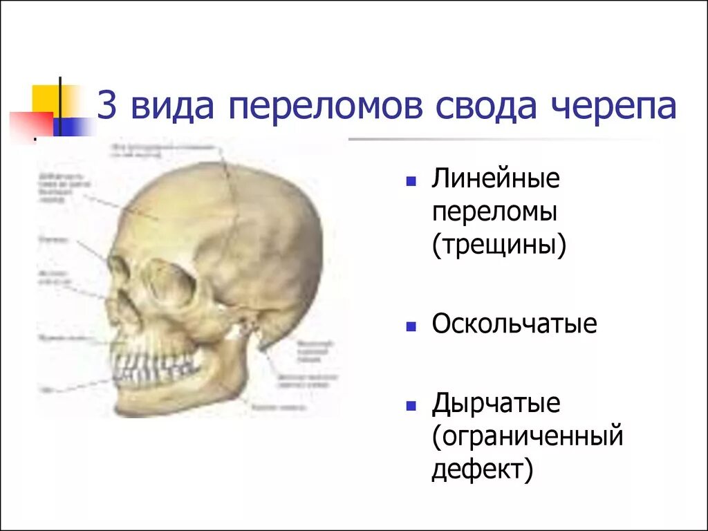 Перелом кости свода черепа. Повреждение костей свода черепа. Классификация переломов костей свода черепа. Перелом свода черепа схема.