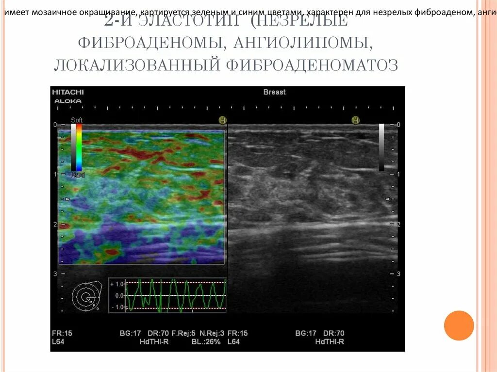 Компрессионная эластография протокол. Компрессионная эластография молочных желез. Эластография протокол УЗИ. Эластография сдвиговой волны щитовидной железы.