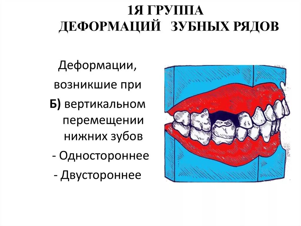 Классификация деформаций зубных рядов. Классификация деформации зубных рядов пономарева. классификация вторичных деформаций зубных рядов. деформация окклюзионной поверхности зубных рядов. классификация вторичных деформаций зубных рядов по пономаревой.