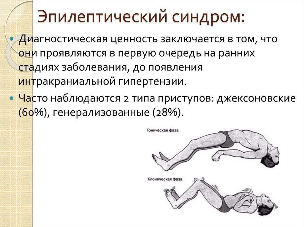 Эпилептический судорожный синдром. Судорожный синдром эпилептический приступ. Эпилепсия судорожный синдром. Эпилепсия синдромы неврология. Какие люди эпилепсии