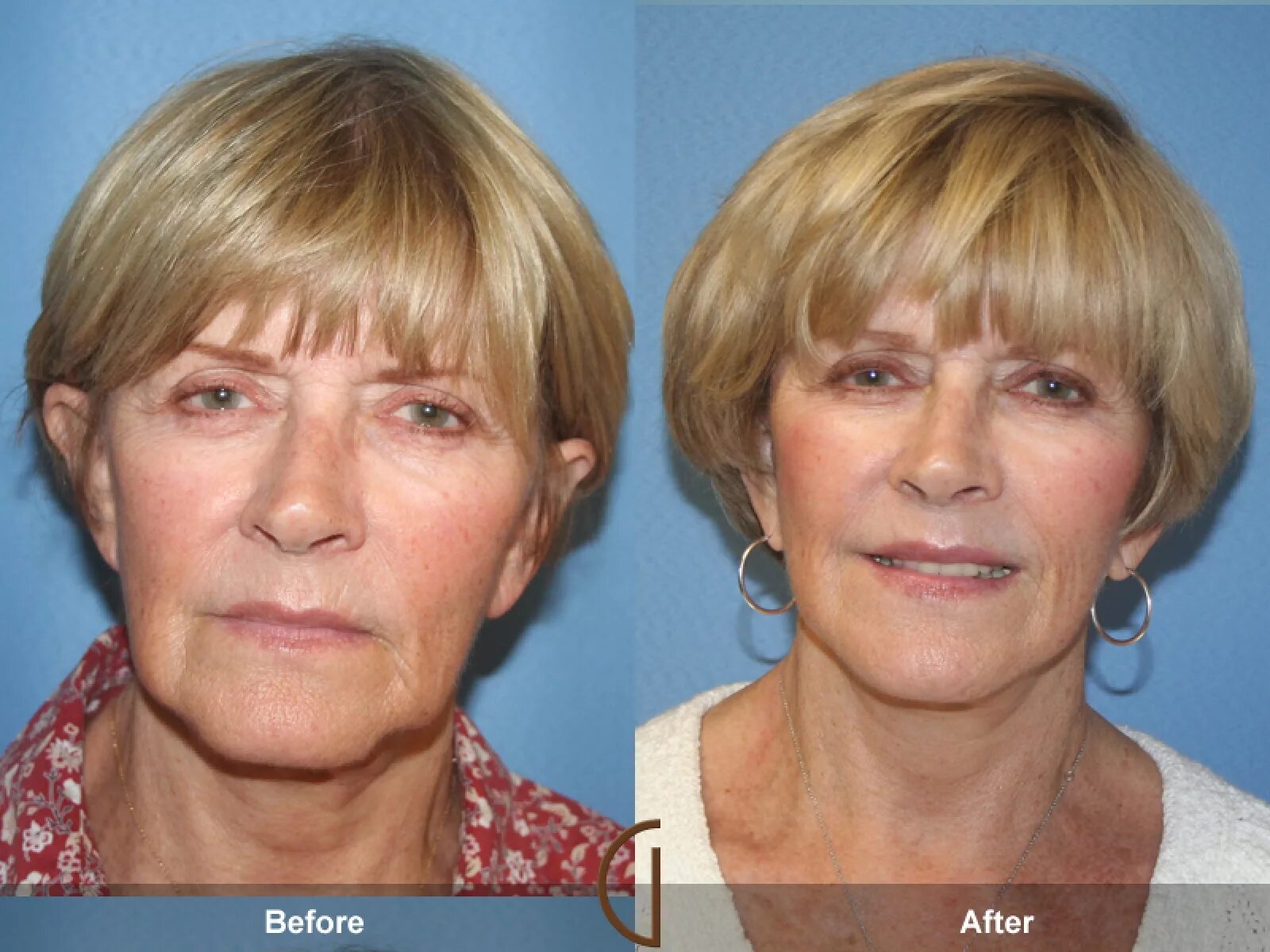 Процедура для лица после 60. Миостимуляции face Lifting. Миостимуляция лица до и после. Микротоки для лица до и после. Миостимуляция лица до и после фото.