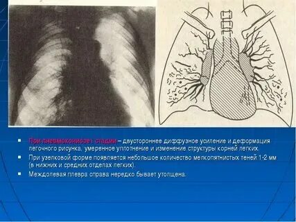 Уплотнение легких что это такое. Уплотнение легких что это такое