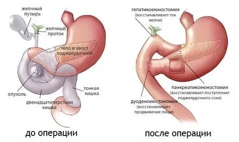 Какие операции на поджелудочной железе