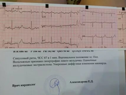 Экстрасистолы в сердце опасно ли