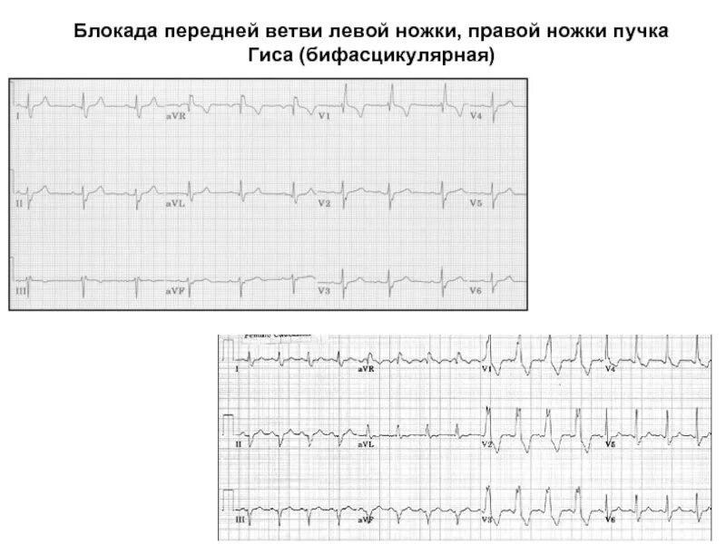 Блокада передне верхнего. Трифасцикулярная блокада пучка гиса. бифасцикулярная блокада на экг. бифасцикулярные блокады ветвей пучка гиса. бифасцикулярная блокада ножек пучка.