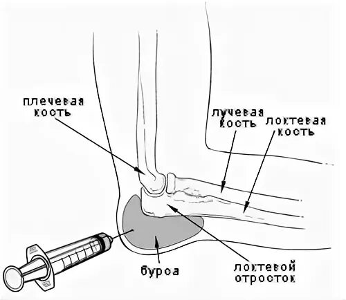 Какой врач лечит локтевые суставы. Бурсит локтевого отростка м70 2. Подкожная синовиальная сумка локтя. Бурситная сумка локтевого сустава. Бурсит локтевого физиотерапия.