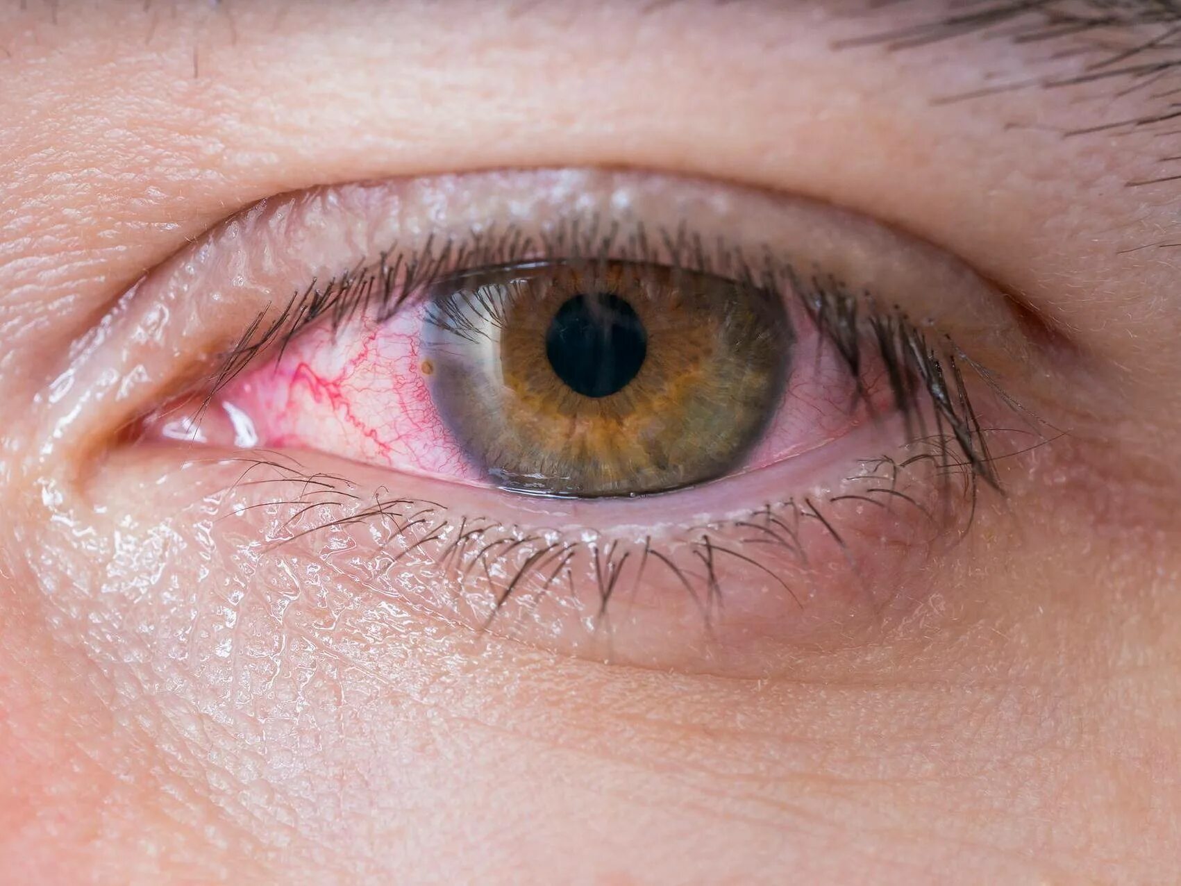 Слезотечение из глаз причины у взрослых. Лимбальный кератоконъюнктивит. Хламидийный конъюнктивит.