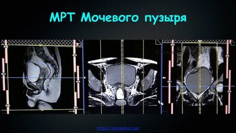 Опущение мочевого пузыря отзывы