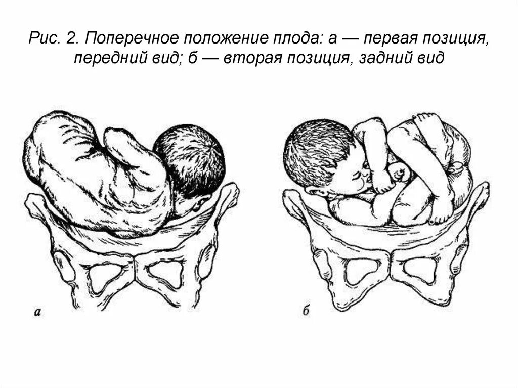 Позиция плода при поперечном положении. Положение предлежание вид и позиция плода. Продольное положение плода первая позиция передний вид. Поперечное предлежание плода 2 позиция. Поперечное положение плода 1 позиция передний вид.