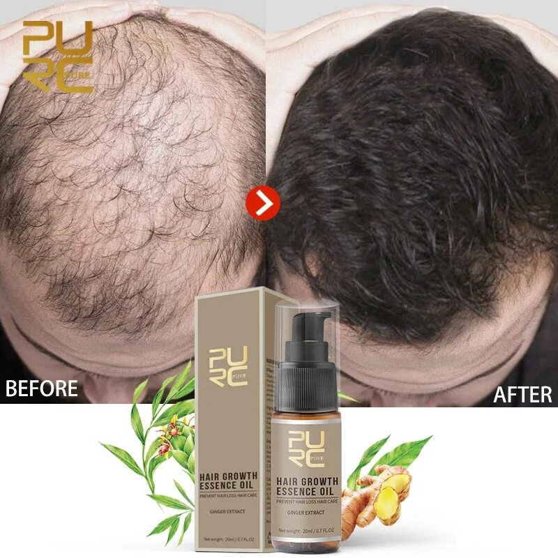 Средство от выпадения для мужчин. Hair growth Essence Oil. Масло от облысения для мужчин. Средство для волос от облысения. Средство для роста волос мужское.