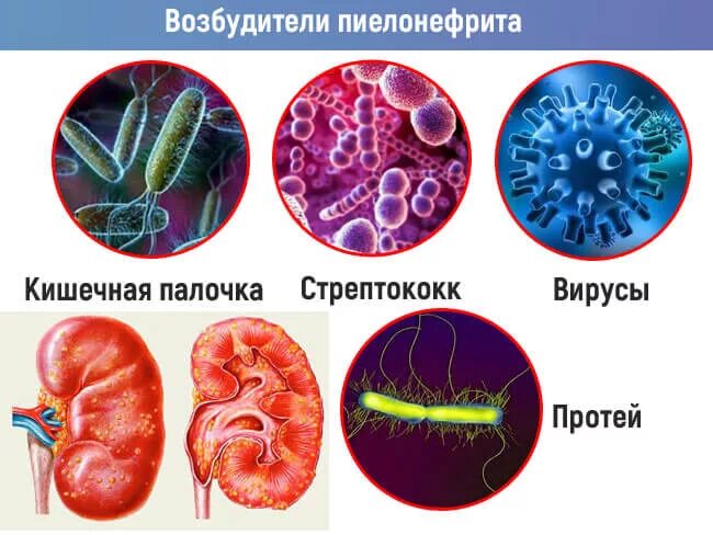 Пиелонефрит бактерии