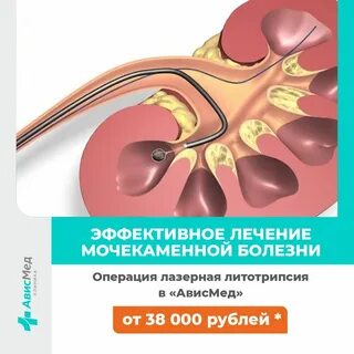 Новинка! Эффективное лечение мочекаменной болезни Операция лазерная литотрипсия.