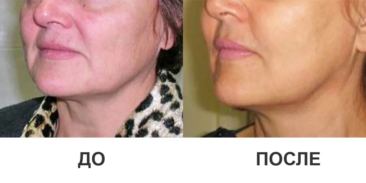 Before & After Photos - New Youth Medical Spa