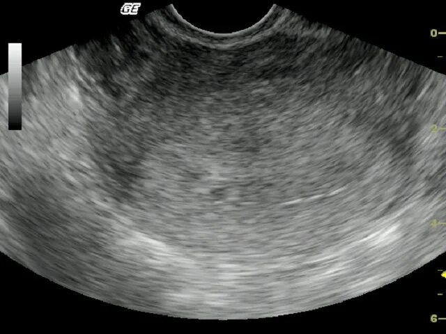 УЗИ беременности плодное яйцо. УЗИ плодного яйца на 2-3 недели. Плодное яйцо в матке УЗИ. УЗИ плодное яйцо 2 недели.