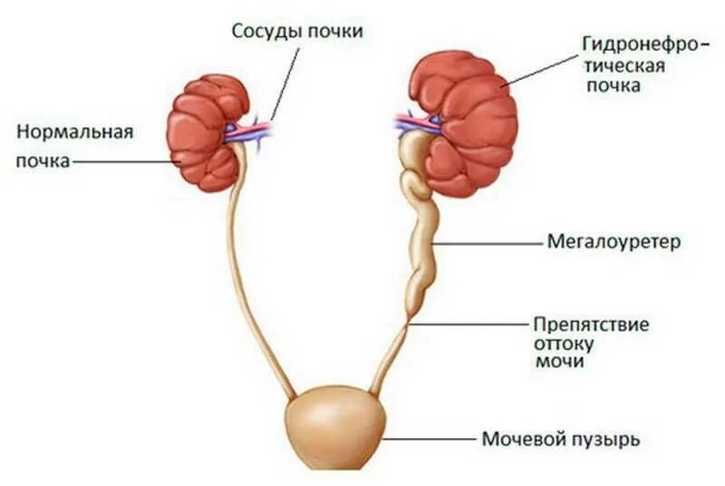 Гидронефроз симптомы у взрослых. Гидронефроз камень в мочеточнике. стадии гидронефроза почки. нарушение оттока мочи из почки. гидронефроз почки у ребенка.