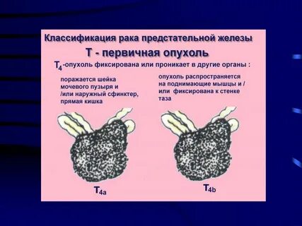 Опухоли рак предстательной железы