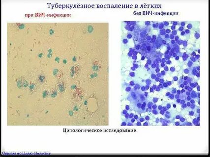 Воспаление в мазке
