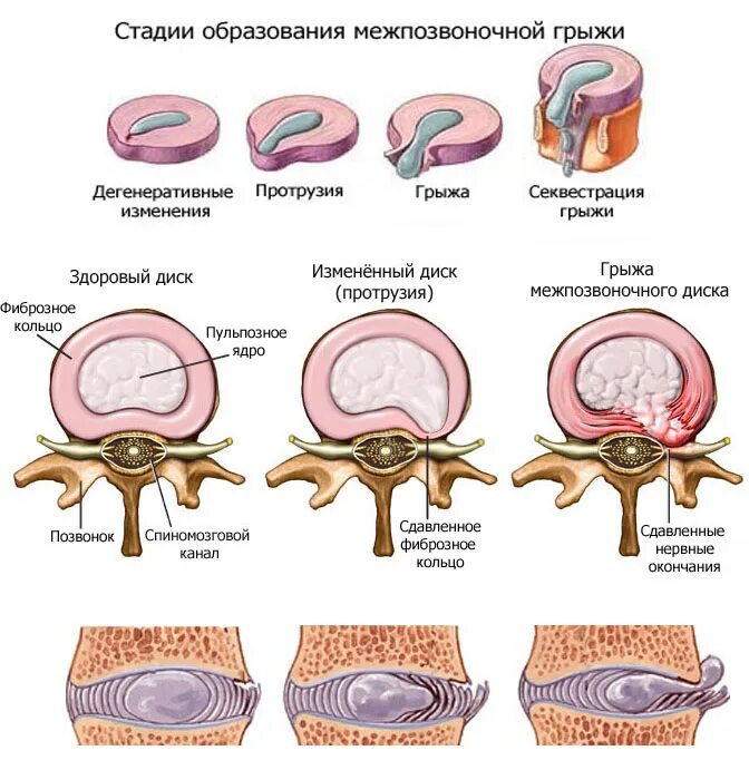 Этапы формирования грыжи позвоночника. Этапы формирования грыжи межпозвоночного диска. Межпозвоночная грыжа пульпозное ядро. Стадии формирования грыжи диска. Диффузное выбухание межпозвоночного