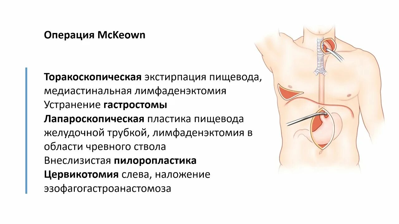 Операции на пищеводе. Наложение гастростомы. Экстирпация пищевода операция.