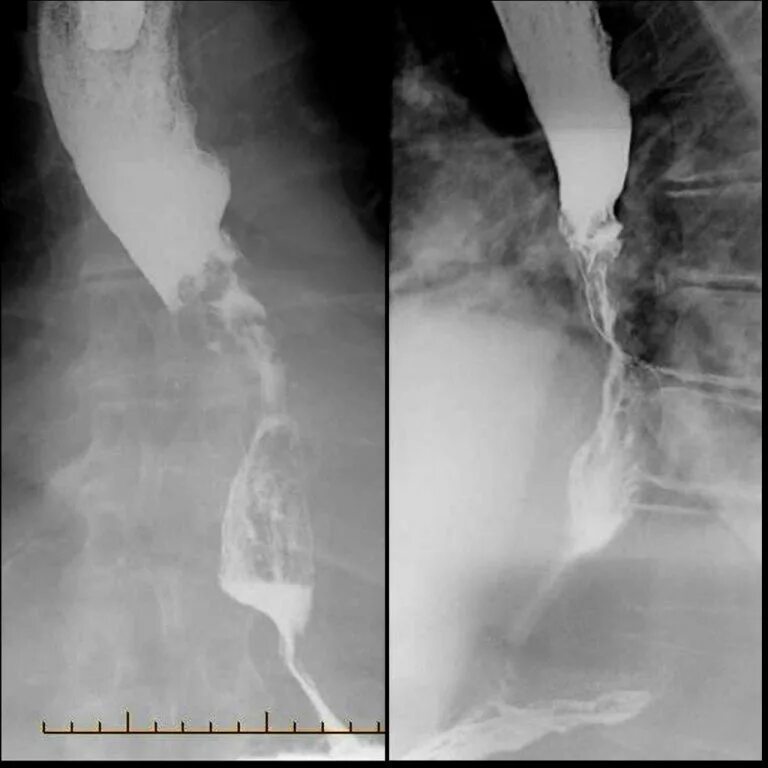 Пищевода с барием. Стриктура пищевода рентген. Склеродермия пищевода рентген. Опухоли щевода рентген. Опухолевая стриктура пищевода.
