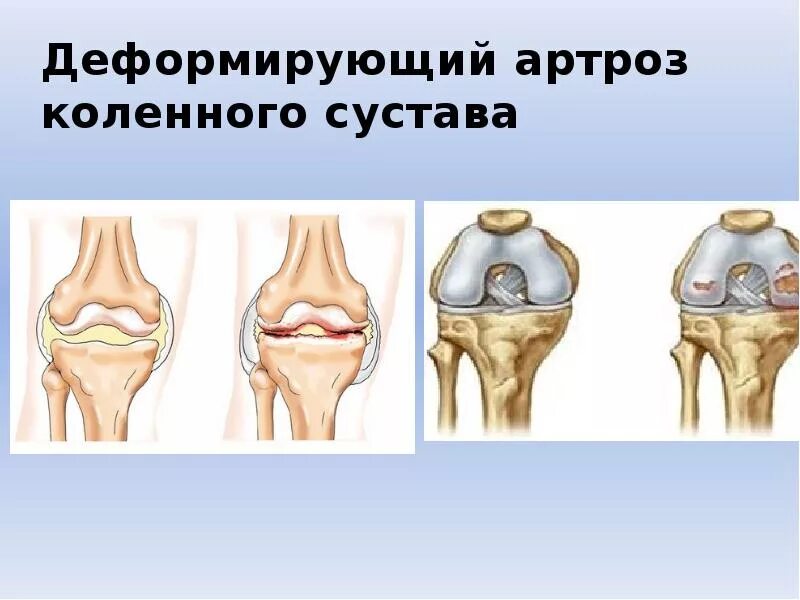 Артроз коленного сустава название. Остеоартроз коленного сустава 2 степени рентген. Деформирующий артроз коленного сустава 3 степени. Деформирующий артроз (остеоартроз). Деформирующий остеоартроз (доа).