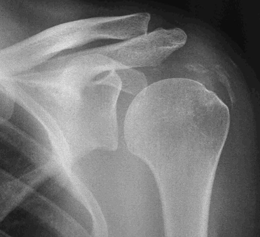 бурсит плеча рентген. кальцинирующий тендинит плечевого сустава. тендинит сухожилия надостной мышцы мрт. бурсит плечевого сустава рентген. кальцинирующий тендинит плечевого.