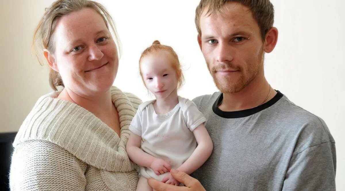 Как называется болезнь маленьких людей. Хагендра тапа магар рост. Хагендра тапа магар. Непалец чандра бахадур данги. Синдром эдвардса микроцефалия.