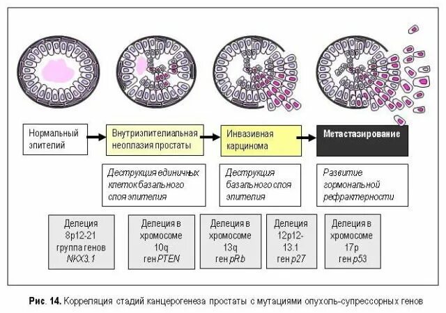 Простатическая интраэпителиальная неоплазия простаты. Пин предстательной железы гистология. Простатическая интраэпителиальная неоплазия гистология. Цервикальная железистая интраэпителиальная неоплазия.