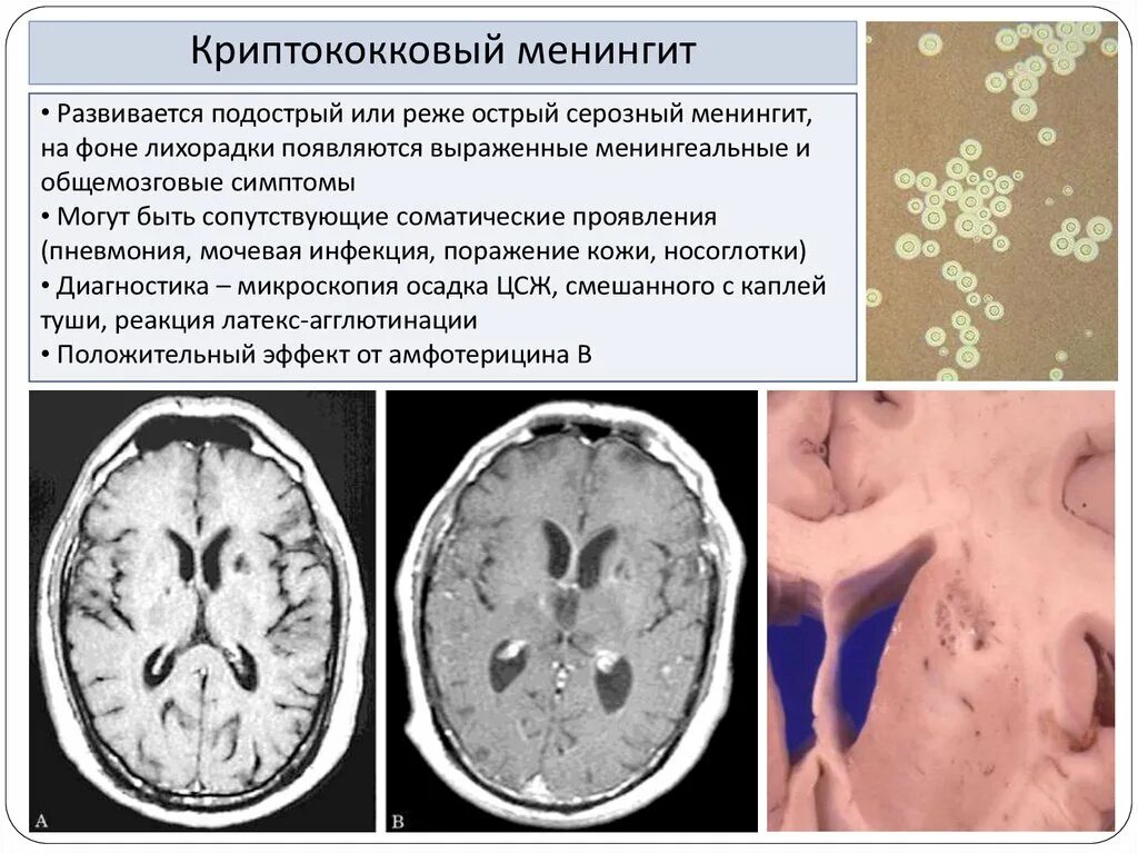 Инфекционные поражения мозга. Менингит воспаление мозговых оболочек. Криптококкового менингита. Криптококкоз менингит. Криптококковый менингит мрт.