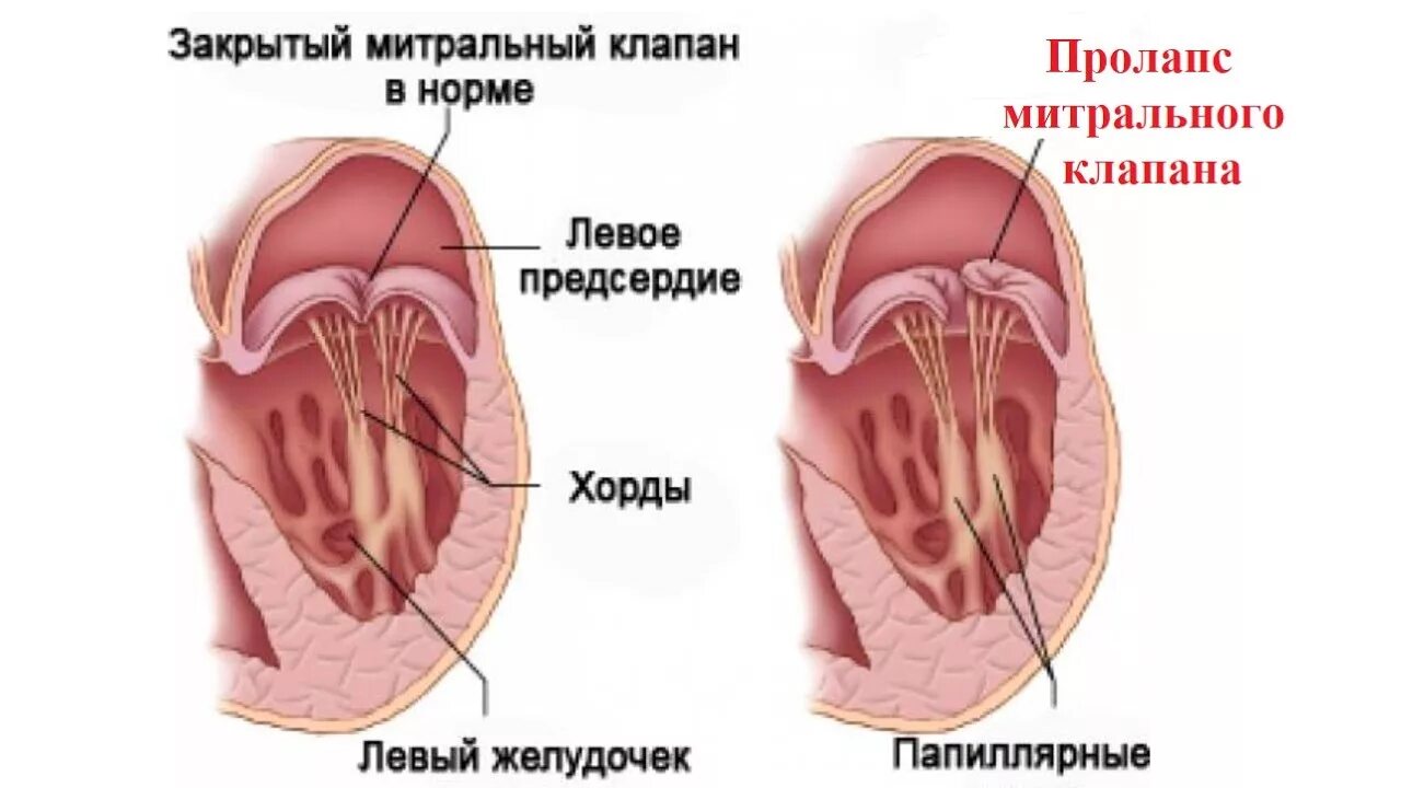 Что такое пролапс митрального клапана. Пролапс митрального клапана 2 степени. Пролапс центрального клапана сердца. Пролапс левого клапана сердца. Пролапс 2 степени сердца что это.