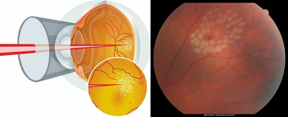 Ювенильная макулодистрофия. Макулодистрофия штаргардта. Периферическая дистрофия сетчатки. Отслойка сетчатки лазерная коагуляция. Лазерная коагуляция после операции